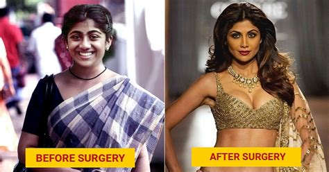 11 Bollywood Actress Who Have Allegedly Undergone Plastic Surgery