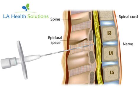 Epidural Steroid Injection Treatment | LA Health Solutions