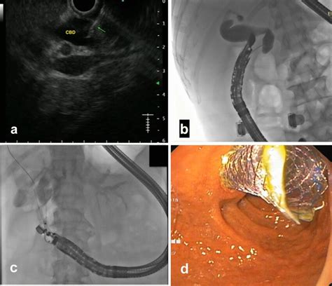 EUS-guided choledochoduodenostomy: a puncture of the dilated CBD with a ...