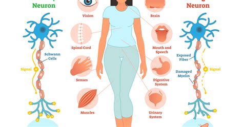 Common Questions About Multiple Sclerosis - UF Health