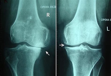 Osteoarthritis Stages Knee