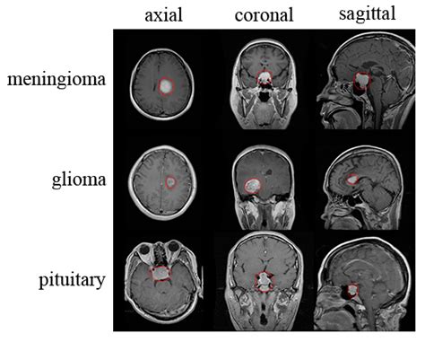 Brain Tumor Color Mri