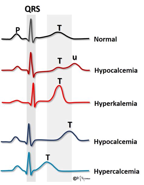 Hyperkalemia Ekg