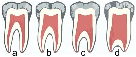 What is Taurodontism? | News | Dentagama