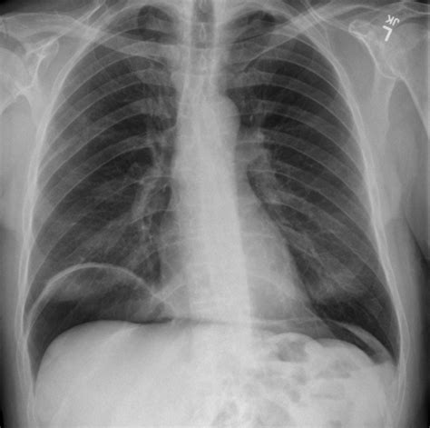 Intestinal Perforation- Pneumoperitoneum – Undergraduate Diagnostic ...