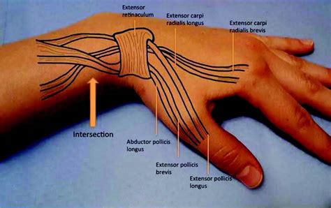 Intersection syndrome causes, symptoms, diagnosis, treatment & prognosis