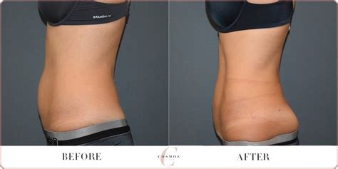 Female Vaser Hi Definition Liposuction Before & After