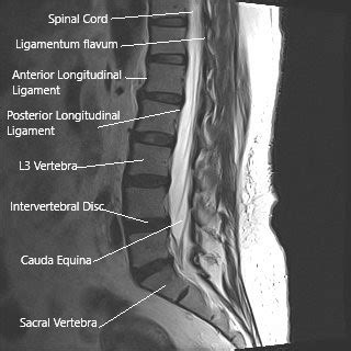 Cauda Equina Cross Section