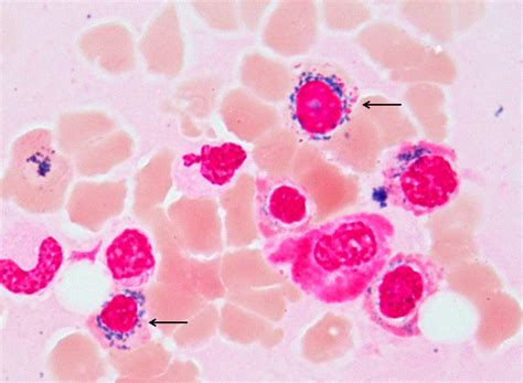 【人気ダウンロード！】 ringed sideroblasts 196813-Ringed sideroblasts are seen in ...