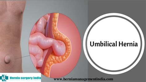 Umbilical Hernia Repair Surgery In Chennai | Hernia Treatment for Fem…