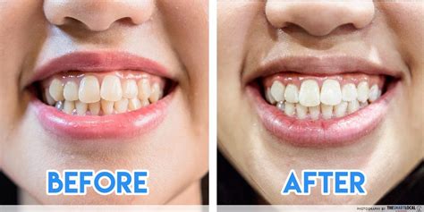 Buy teeth whitening and cleaning home kit in affordable price. You may ...