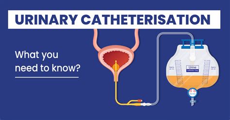 Urinary catheterisation – Uses, types and complications - Star Health