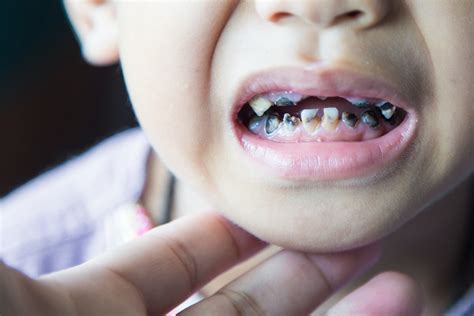 Microbiomes play ‘major’ role in childhood caries | DrBicuspid.com