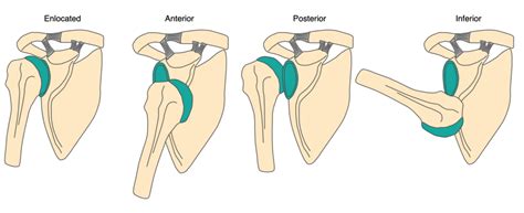 Shoulder Dislocation – OrthoSHO