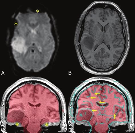 Sample patient with a right temporal lobe tumor. The upper row ...