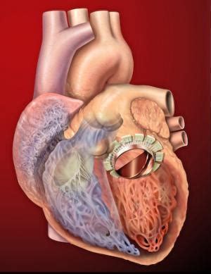 Complications after mitral valve replacement | General center ...