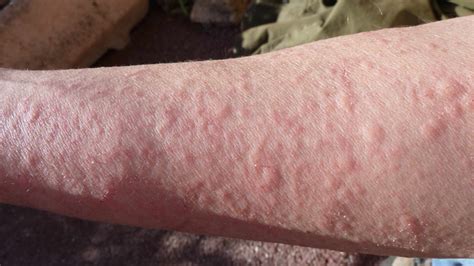 Hives: Causes, Risks, Prevention, and Pictures