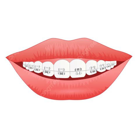 Beautiful White Teeth With Braces Smile, Smile, White Teeth, Braces PNG ...