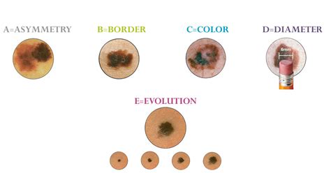 Melanoma Skin Cancer Stages