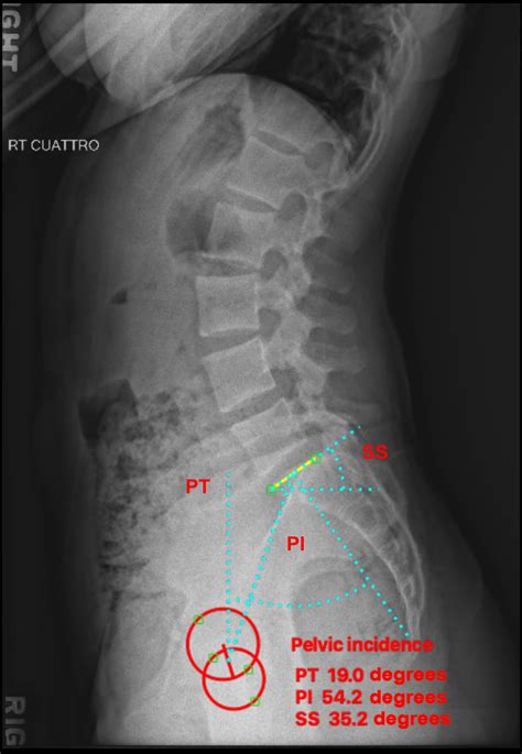 Lumbar Vertebrae Anatomy Xray