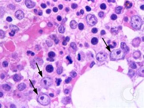 Myelodysplastic Syndrome: Refractory Anemia with Ringed Sideroblasts ...