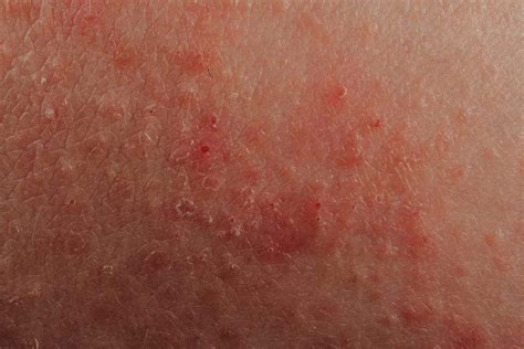 Eczema: Signs, Symptoms, and Complications