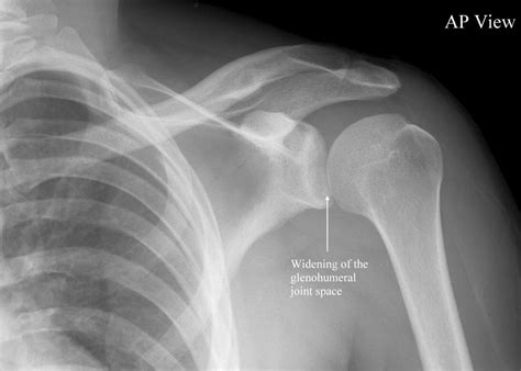 Posterior Shoulder Dislocation • LITFL • Trauma Library