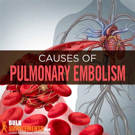 Pulmonary Embolism: Causes, Symptoms & Treatment