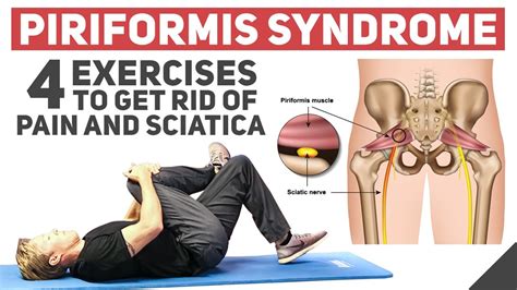 How To Relieve Piriformis Syndrome - Aimsnow7