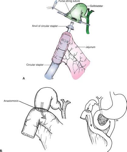 Choledochoduodenostomy and Other Biliary Bypass Procedures ...