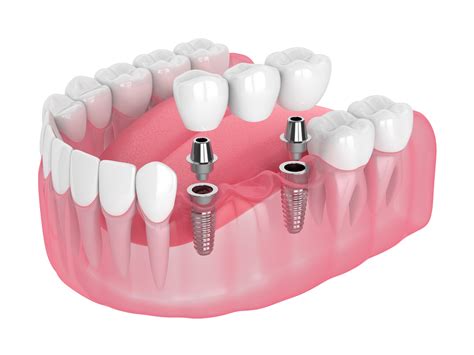 What is an Implant Bridge? — DFW Implant Team ┃ Donald Steinberg, DDS