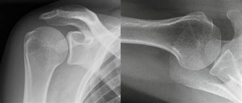 Shoulder Osteoarthritis - Zahab Ahsan, MD