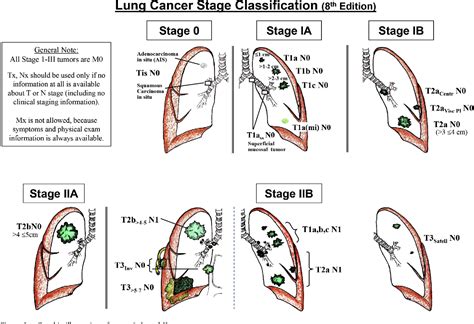 Stages Of Lung Cancer