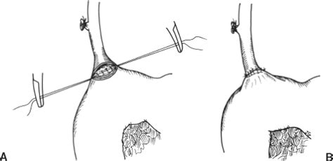 Choledochoenteric Anastomosis by Choledochoduodenostomy and Other ...