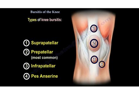 Bursitis of Knee — OrthopaedicPrinciples.com