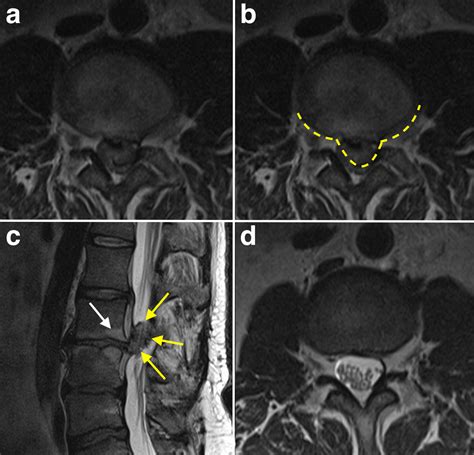 Cauda Equina Compression - MRI - Radiology at St. Vincent's University ...