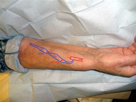 Arterio-Arterial Fistula