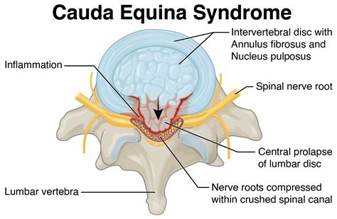 Cauda Equina Syndrome – C. Jones and Associates, LLC