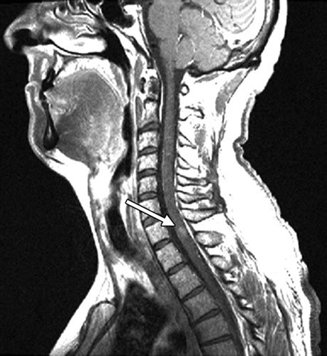 Cervical Spine Mri Multiple Sclerosis