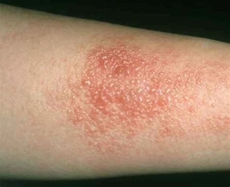 Contact dermatitis: Causes, Symptoms and Prevention | Contact ...