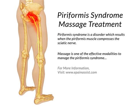 Piriformis Syndrome Massage Treatment, Piriformis Muscle Massage ...