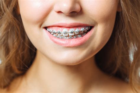 Orthodontic Treatment. Dental Care Concept. Beautiful Woman Healthy ...