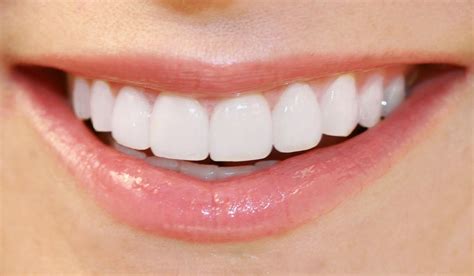 Porcelain Veneers | Portage Park Dental