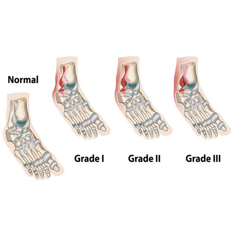 Ankle Sprain Grades