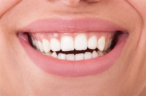 North Hollywood Dentist Explains How Veneers Blend With Your Smile