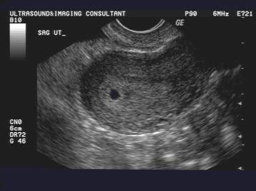 What to Expect for Ultrasound at 4 Weeks: Pictures and Videos | New ...