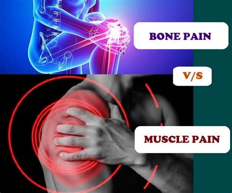 Bone Pain vs Muscle Pain in CKD - All Things Kidney ~ Official