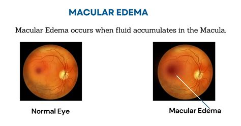 Cystoid Macular Edema (CME) Treatment in Delhi | Causes & Prevention