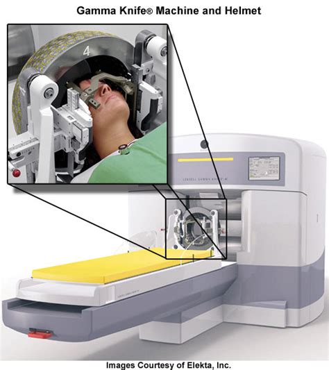 Team AVM: Gamma Knife Surgery - One of the Most Effective Solutions for ...