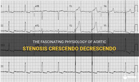 The Fascinating Physiology Of Aortic Stenosis Crescendo Decrescendo ...